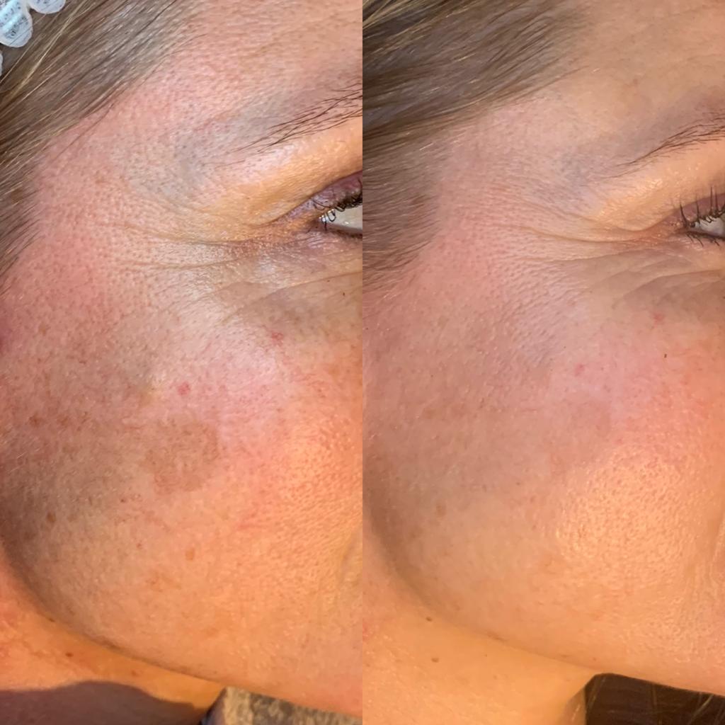 microneedling voor en na fotos beverwijk