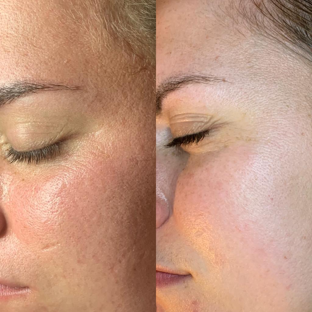 microneedling voor en na fotos beverwijk