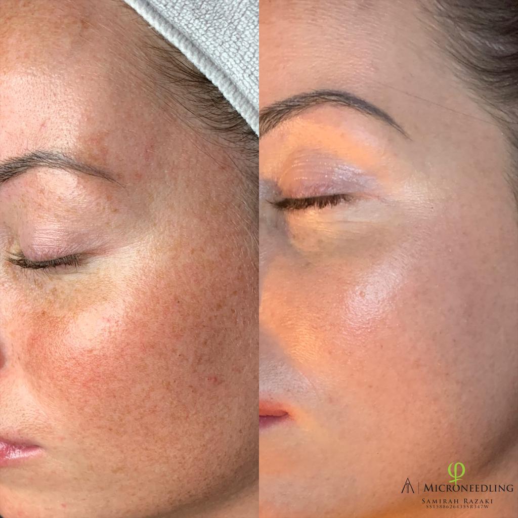 microneedling voor en na fotos beverwijk