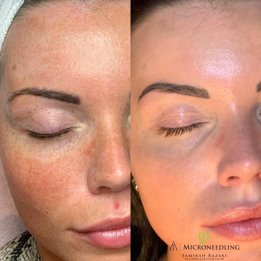 microneedling voor en na fotos beverwijk